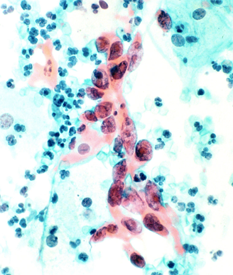 cytology-cervical-cancer-328-pd